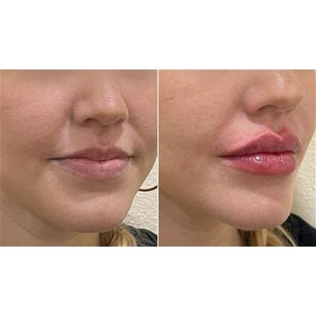 Juvederm Ultra 4 Lidocaine for Sale in USA