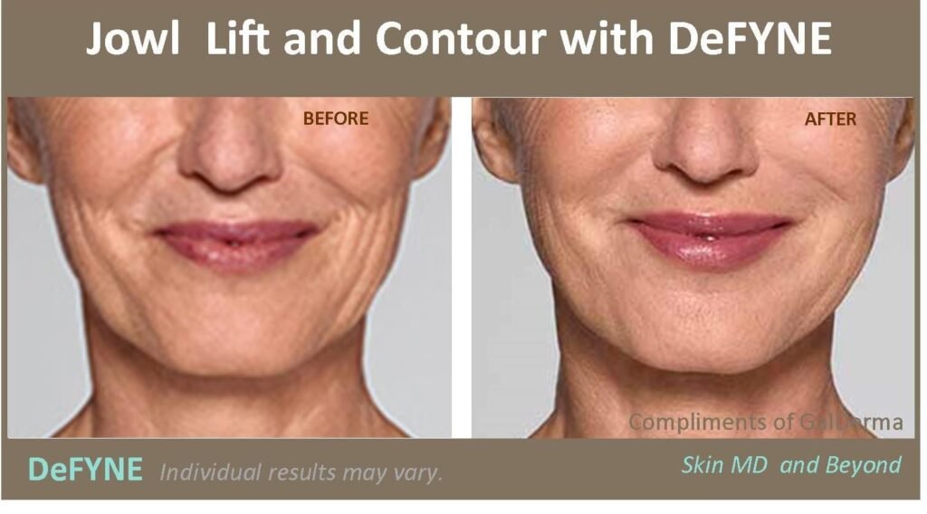 Restylane Defyne Lidocaine for Sale USA